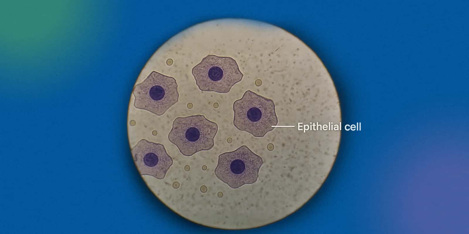 Causes of High Epithelial Cells in Urine