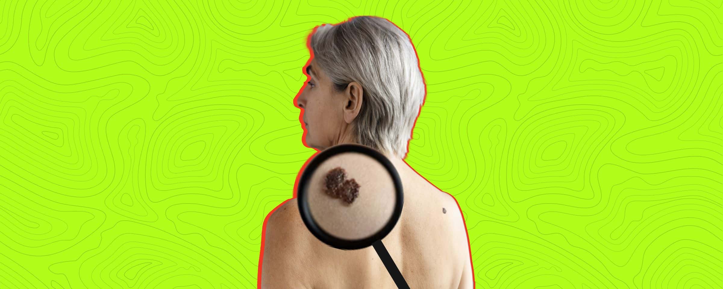 Does Skin Cancer Always Mean Having Melanoma?