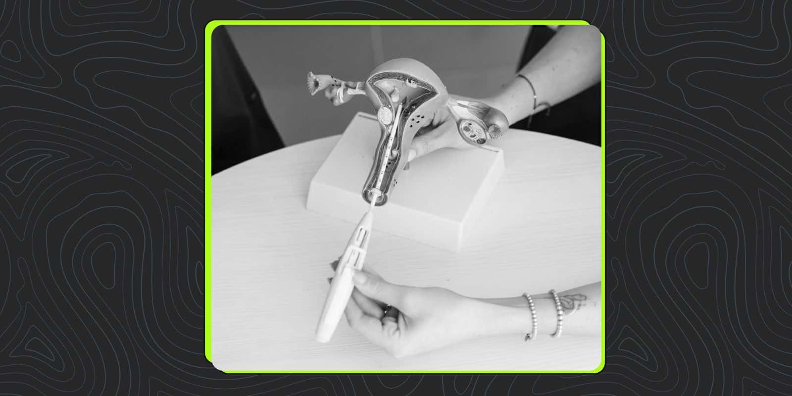 Long-Acting Reversible Contraceptives (LARCs)