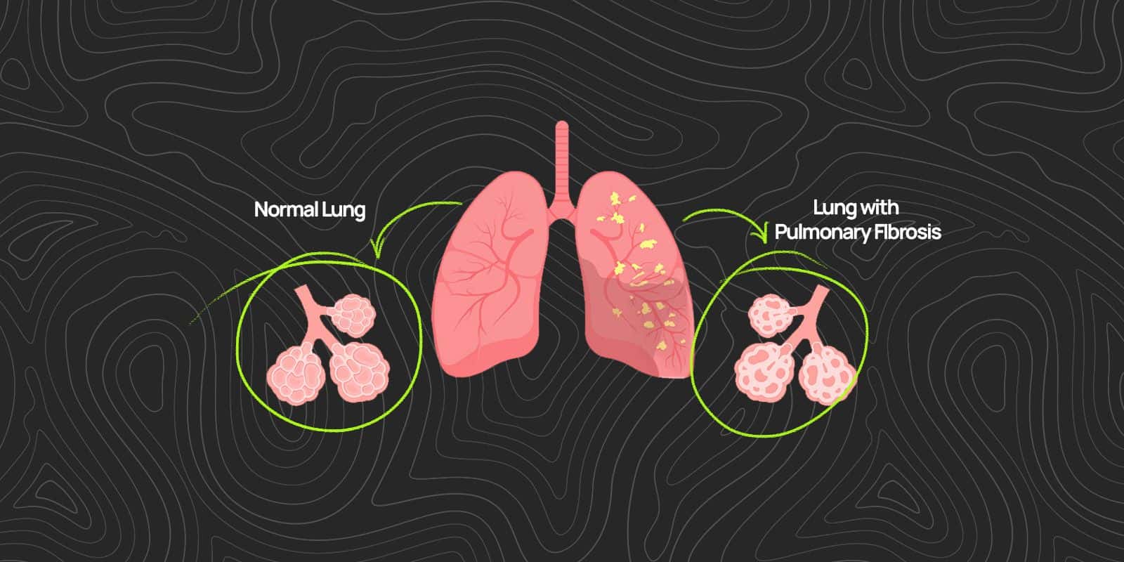 Idiopathic Pulmonary Fibrosis Symptoms