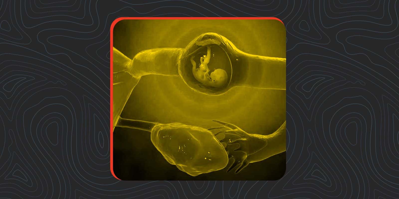 Contraception After a Miscarriage