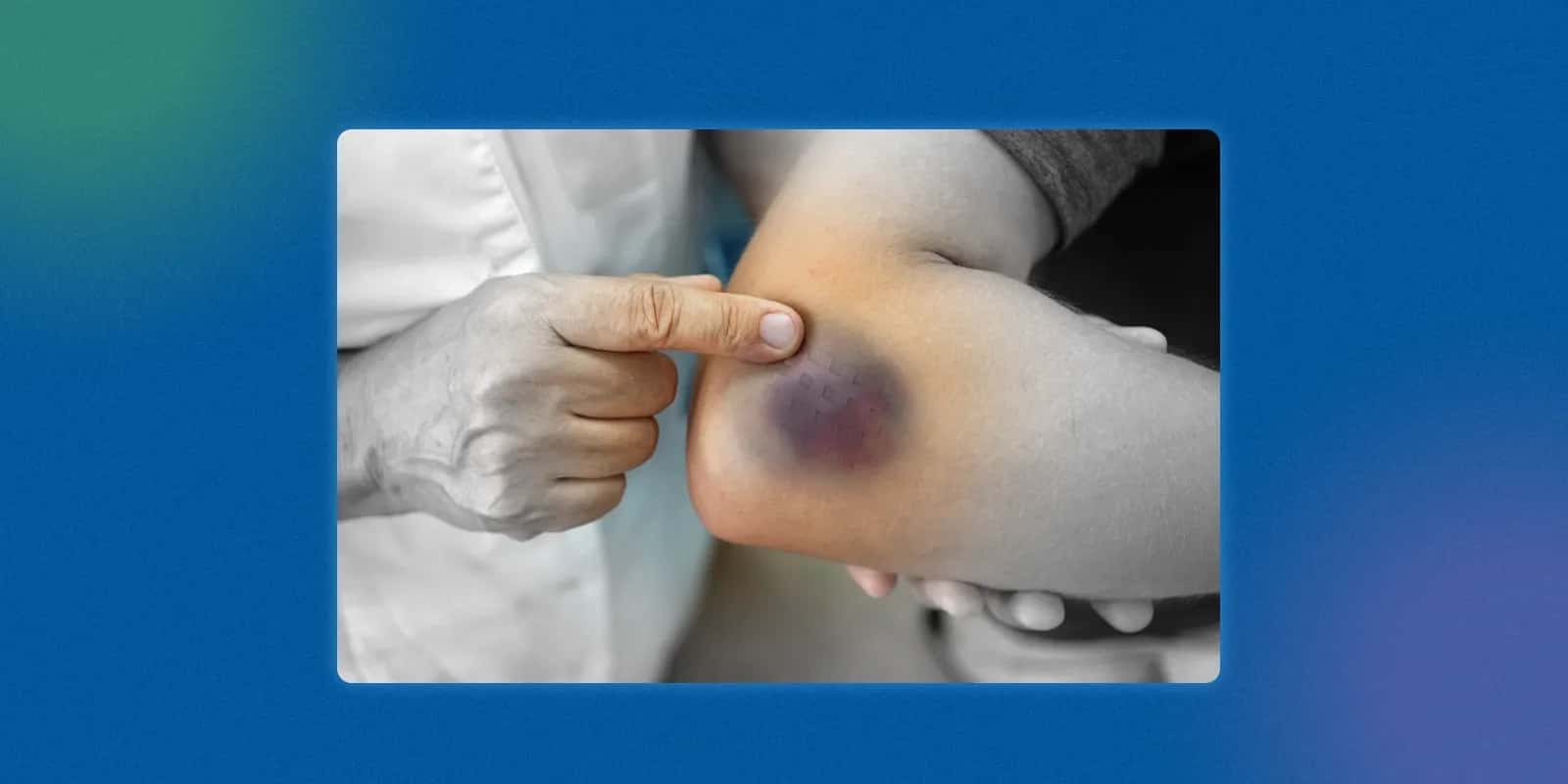 What Are the Symptoms of Haemophilia? 