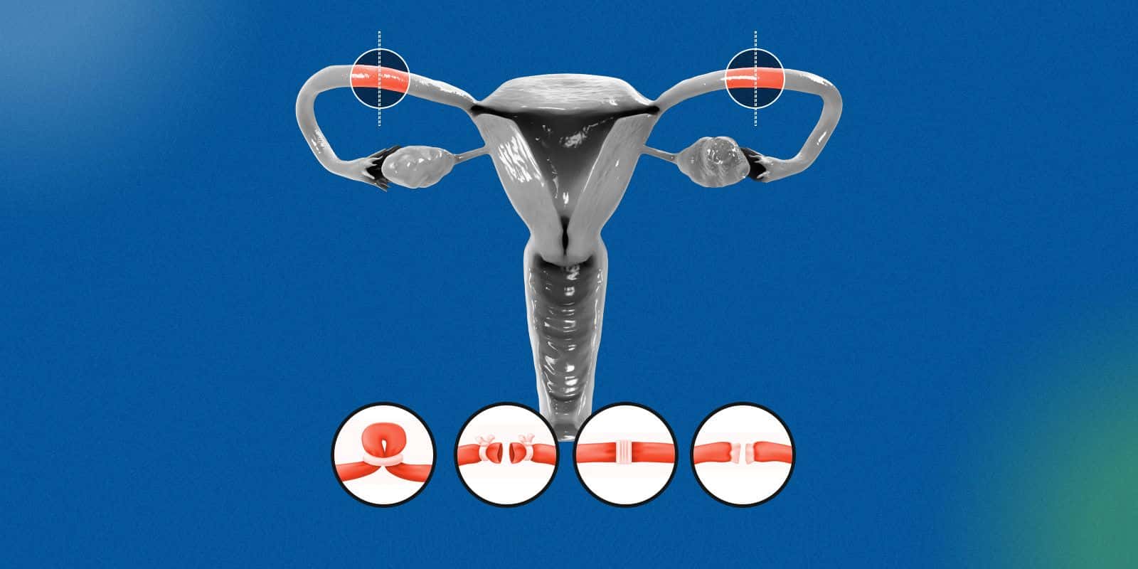 How to Prevent Ovarian Cancer 