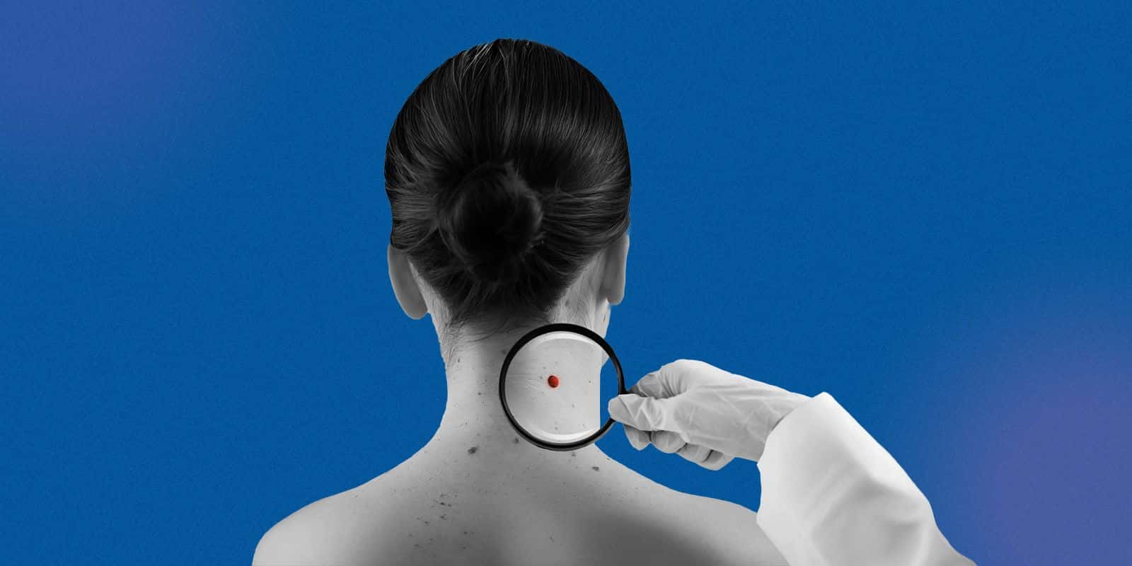 Signs of Merkel Cell Carcinoma