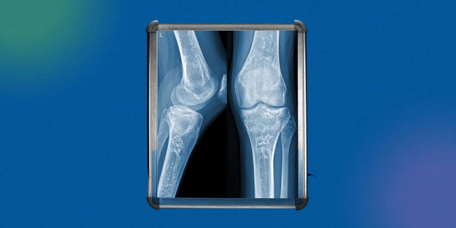 Common Symptoms of Fibrosarcoma
