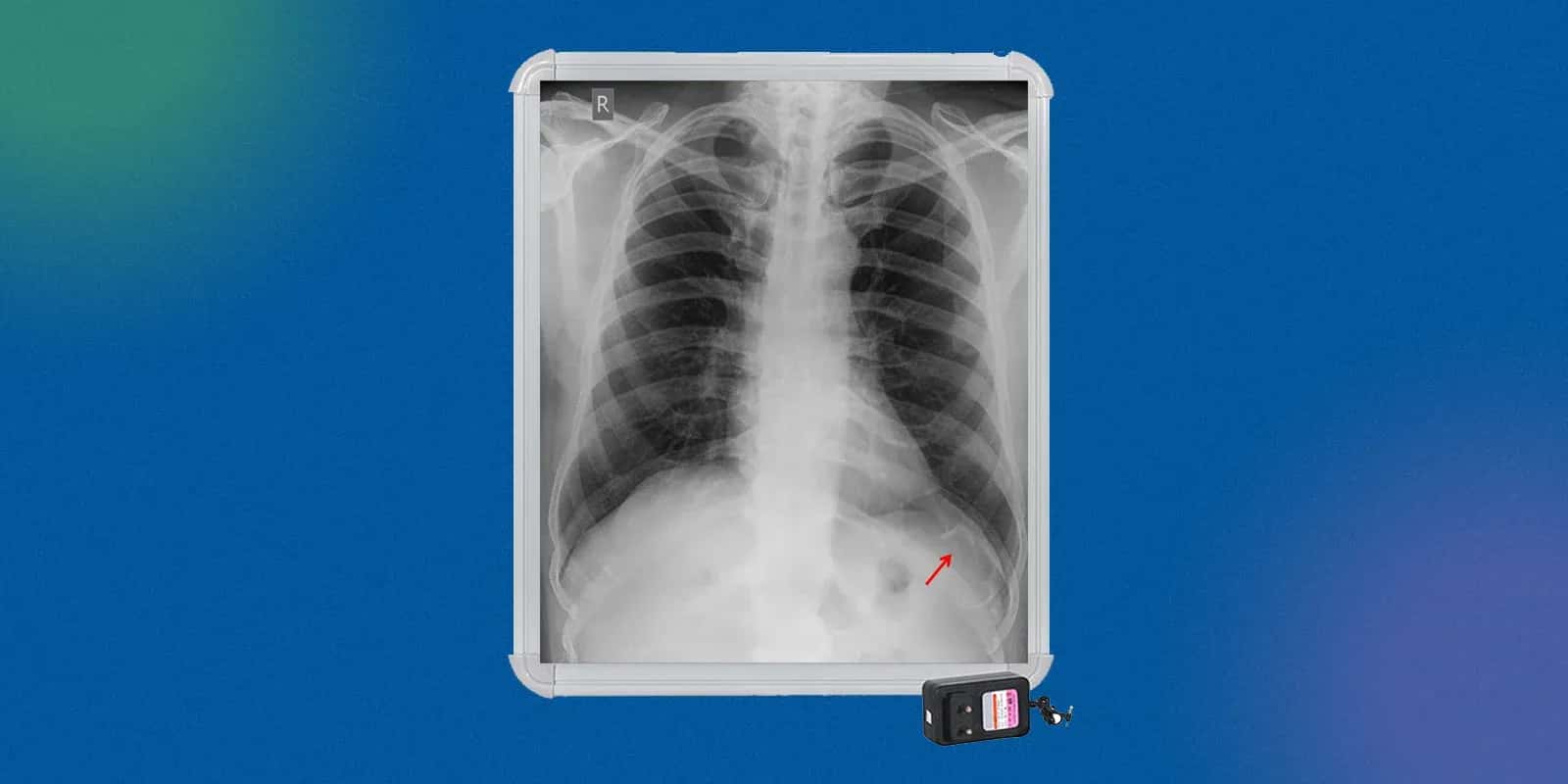 How Do You Diagnose Such a Rare Cancer of the Bone? 