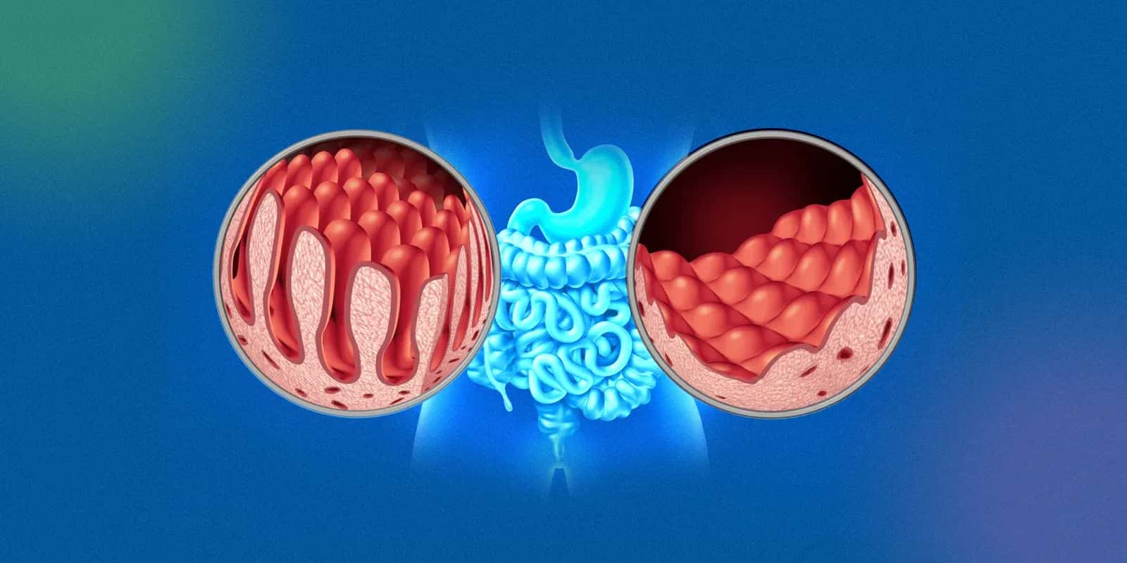 Coeliac disease 