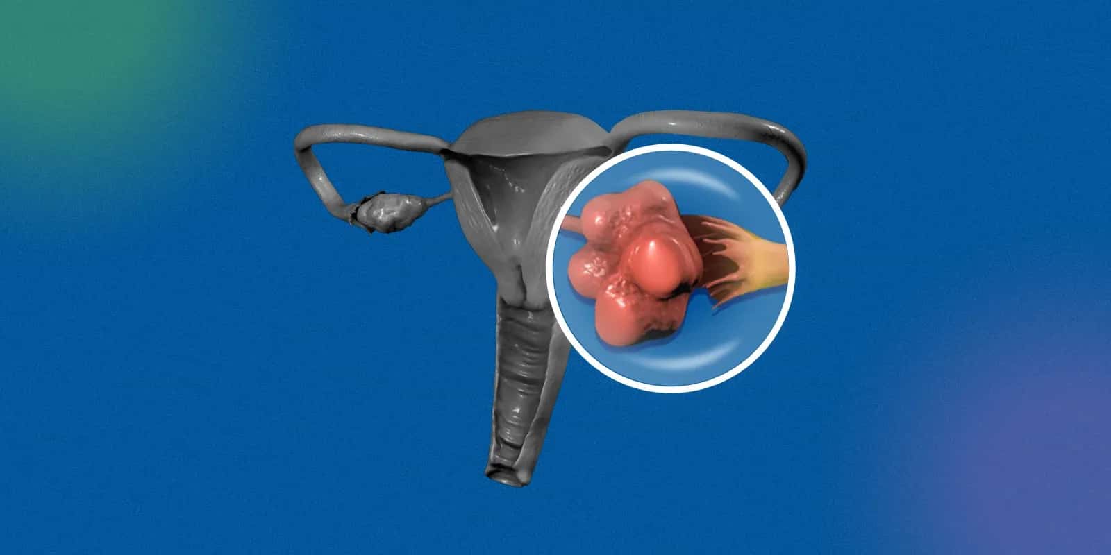 The Basics: Healthy Liver vs Fatty Liver 