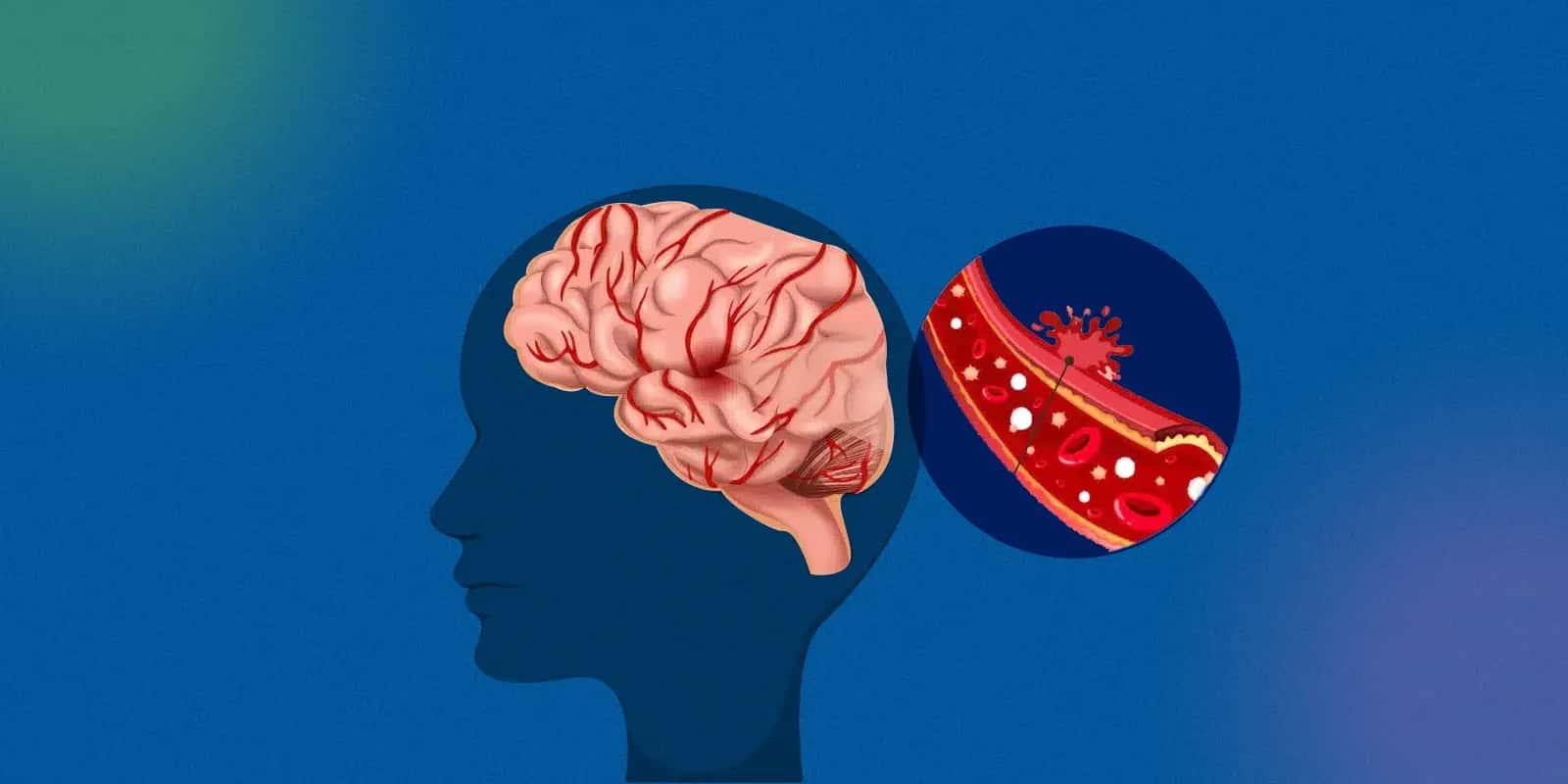 Thunderclap Headache Causes