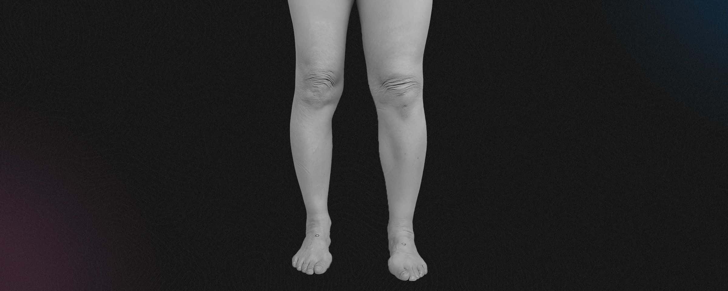 Kidney Cancer Causing Your Legs to Swell? Here’s Why? 