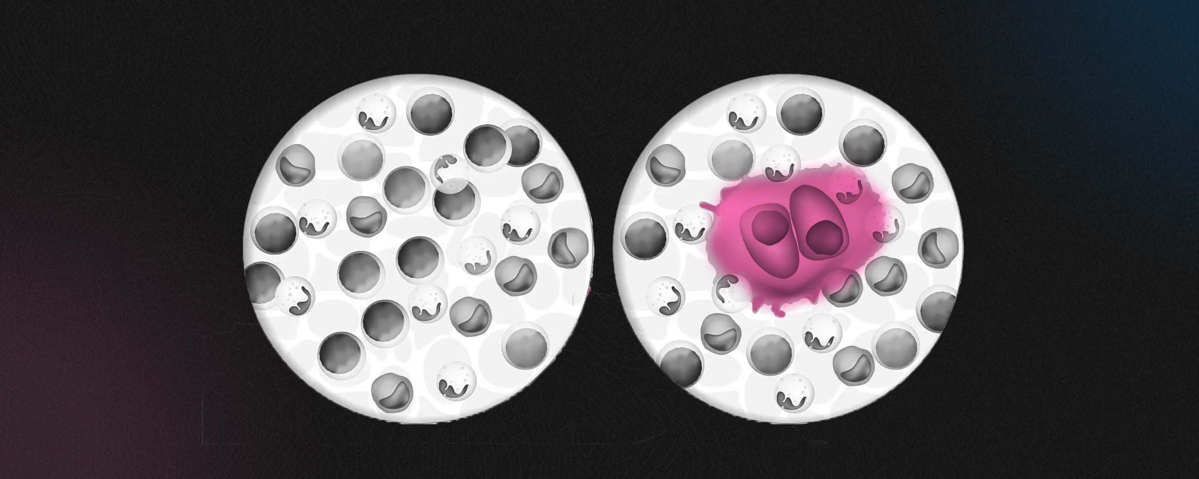 Hodgkin’s vs Non-Hodgkin’s Lymphoma: Key Differences