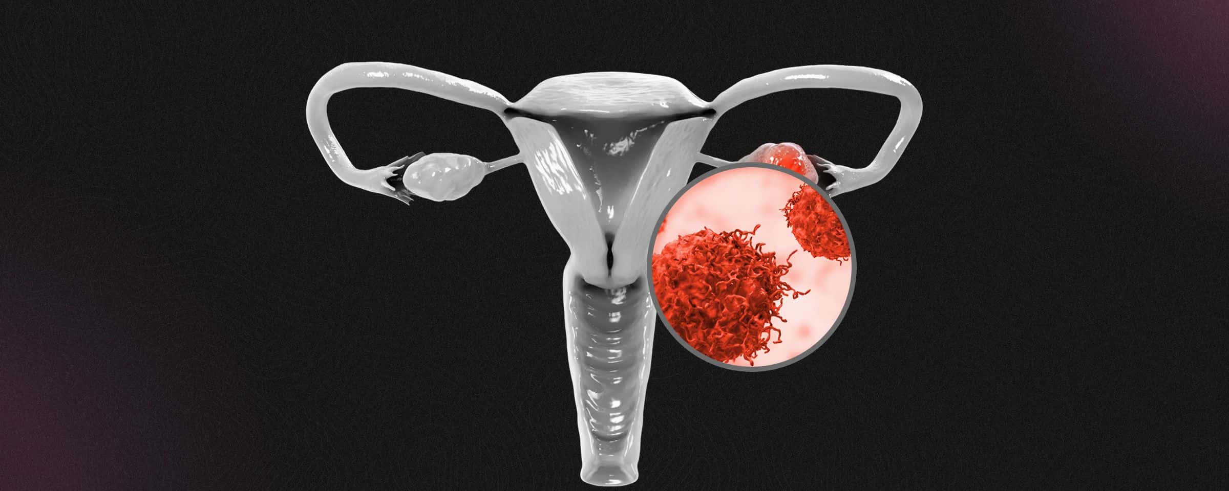 Ovarian Cancer - Symptoms, Causes, Diagnosis and Treatment 