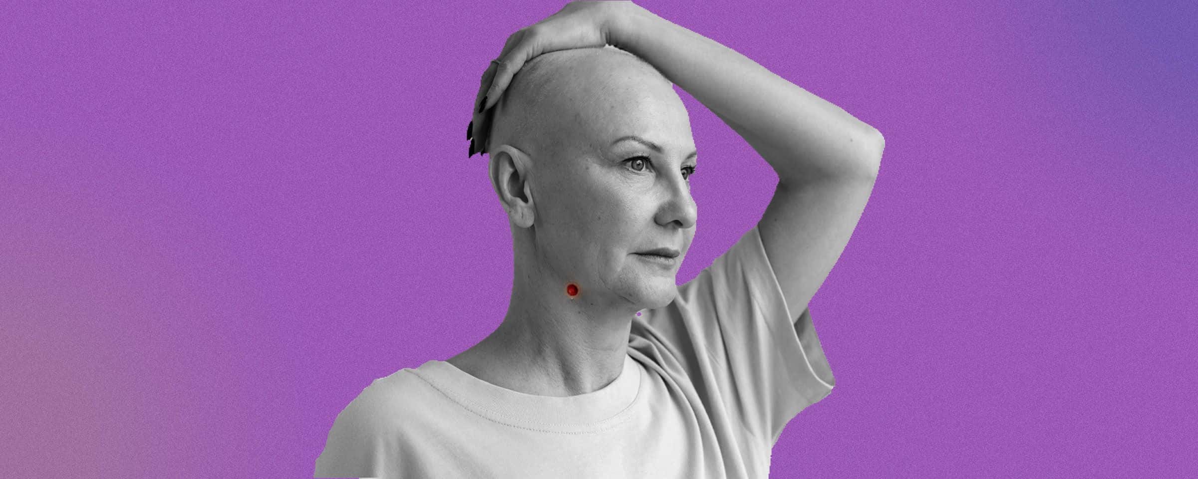 Merkel Cell Carcinoma - What You Need to Know 