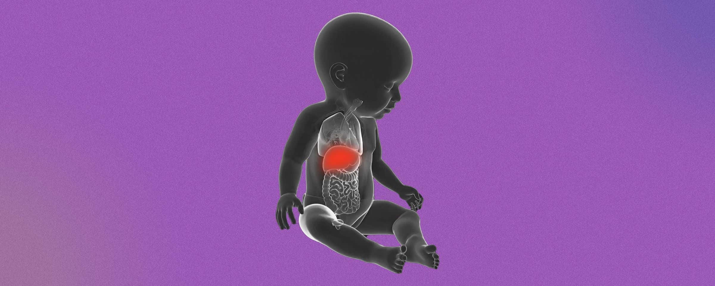 Hepatoblastoma-Liver Cancer in Children