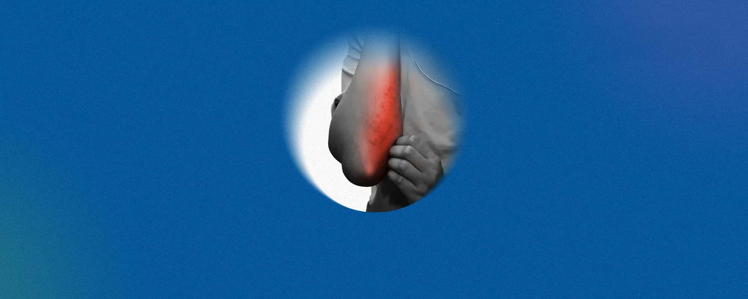 Anxiety Rash - A Lesser Known Evil Or Maybe More?