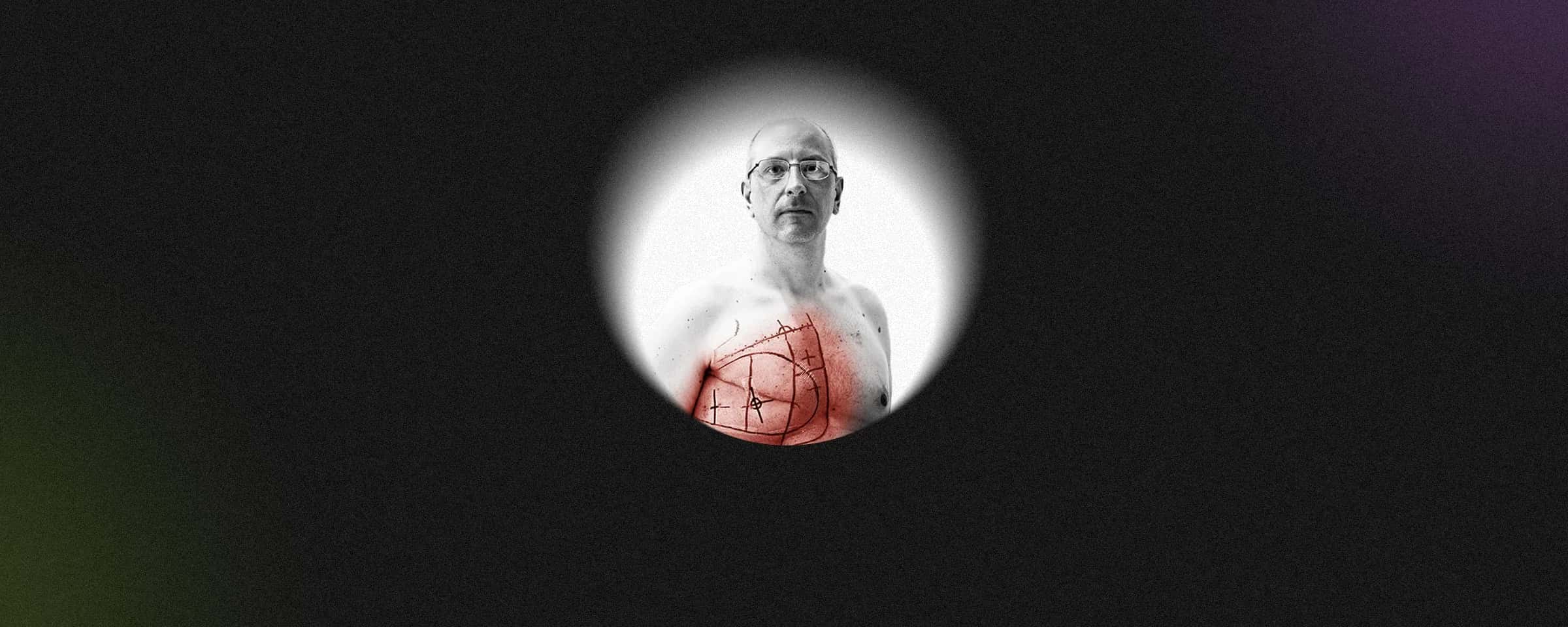 The Detailed Guide To Male Breast Cancer