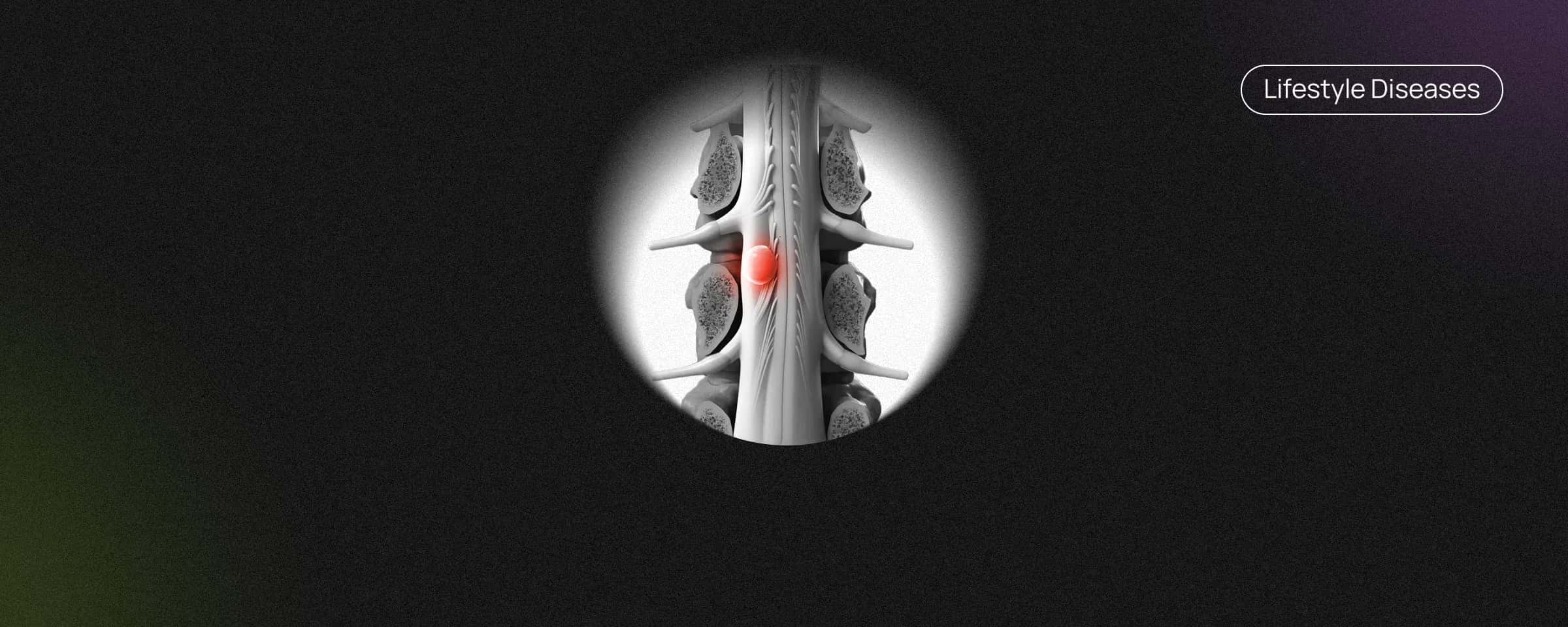 Chordoma - Causes, Symptoms, Treatment