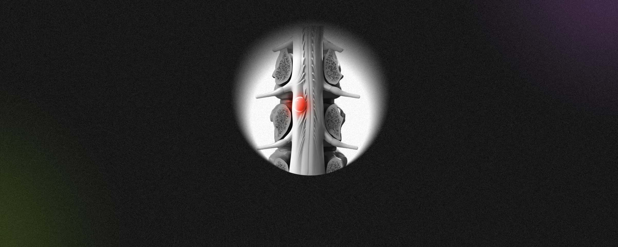 Chordoma - Causes, Symptoms, Treatment