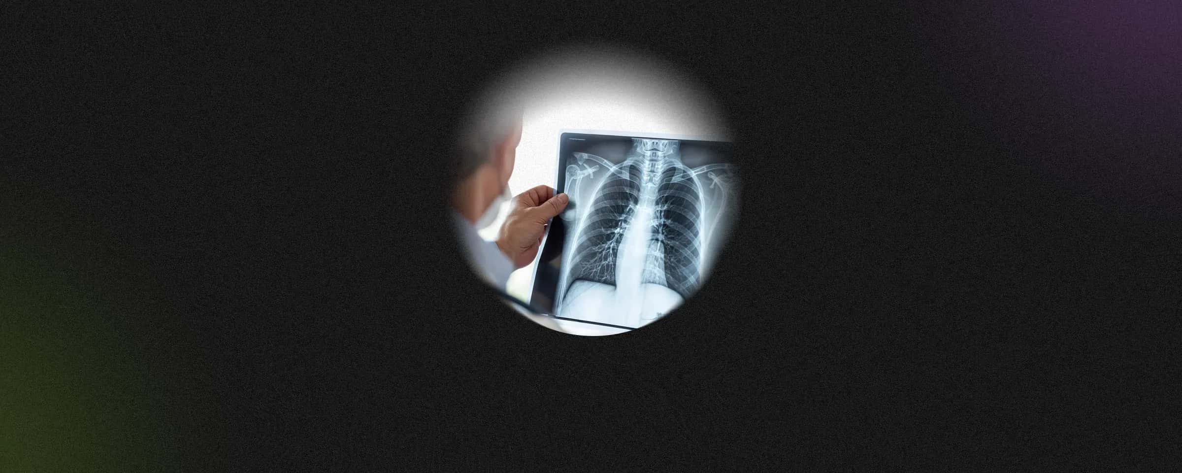 Chondrosarcoma- A Rare Cancer Not To Be Overlooked
