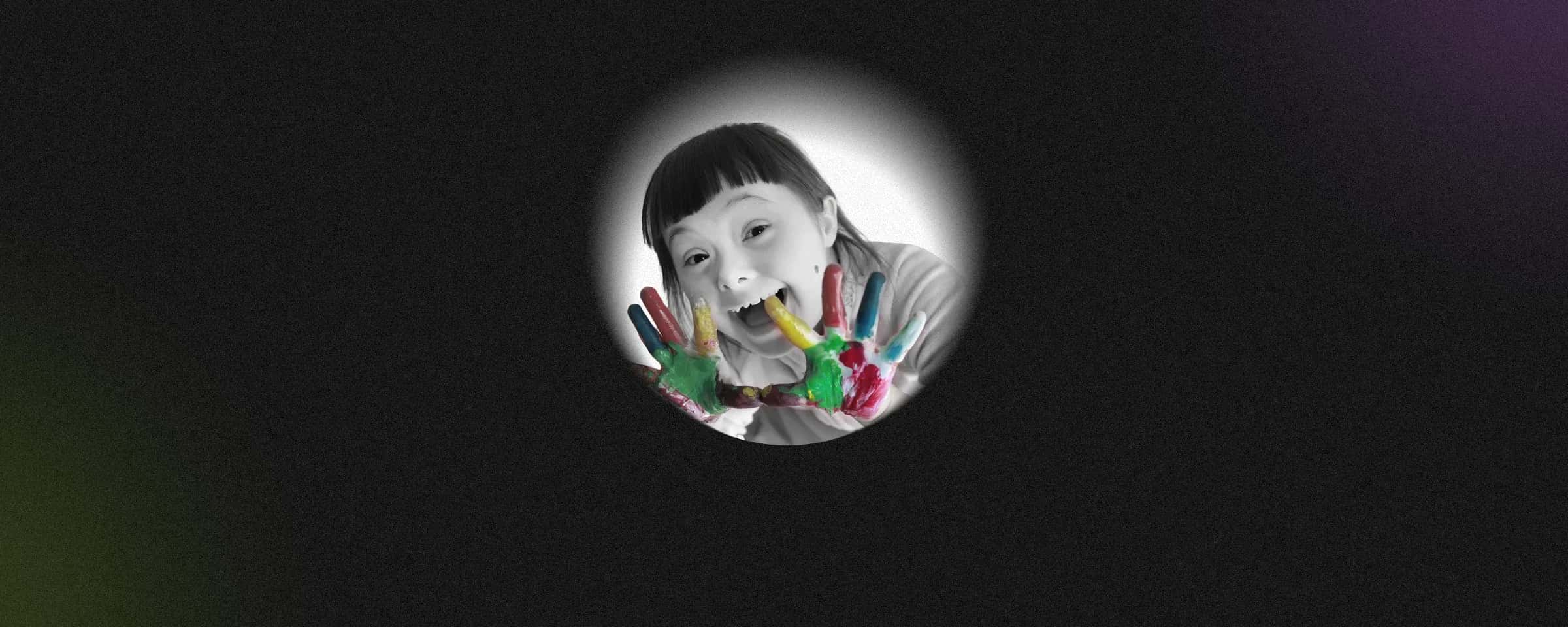 Everything You Need To Know About Down syndrome 