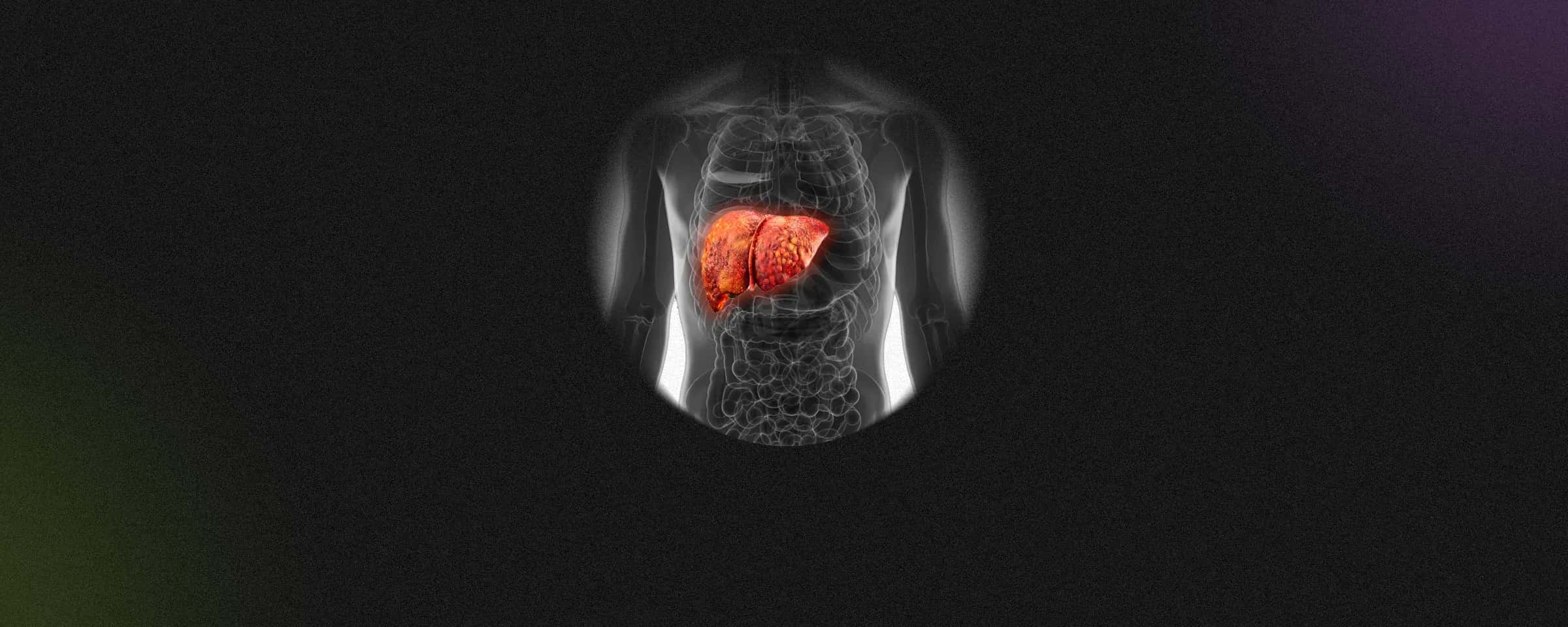 Non-alcoholic Fatty Liver Disease: Causes, Diagnosis, and Prevention