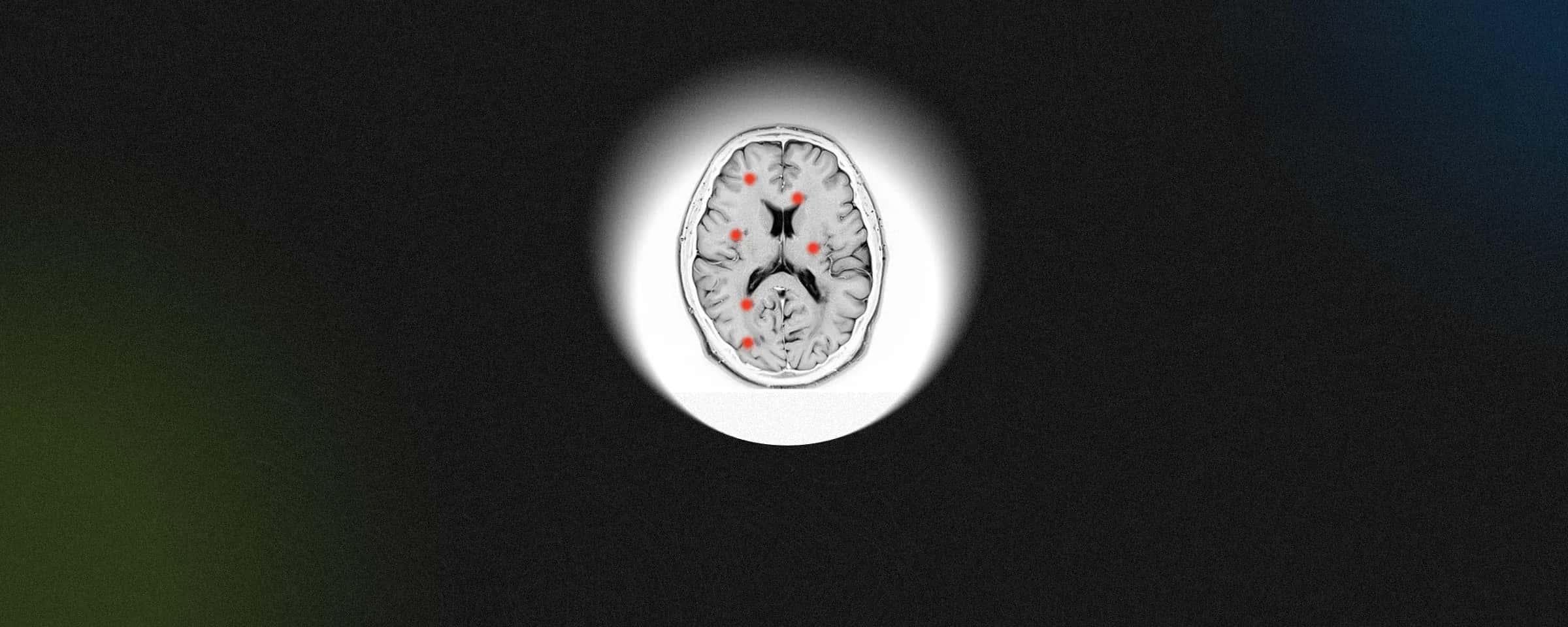 Everything You Need To Know About Multiple Sclerosis