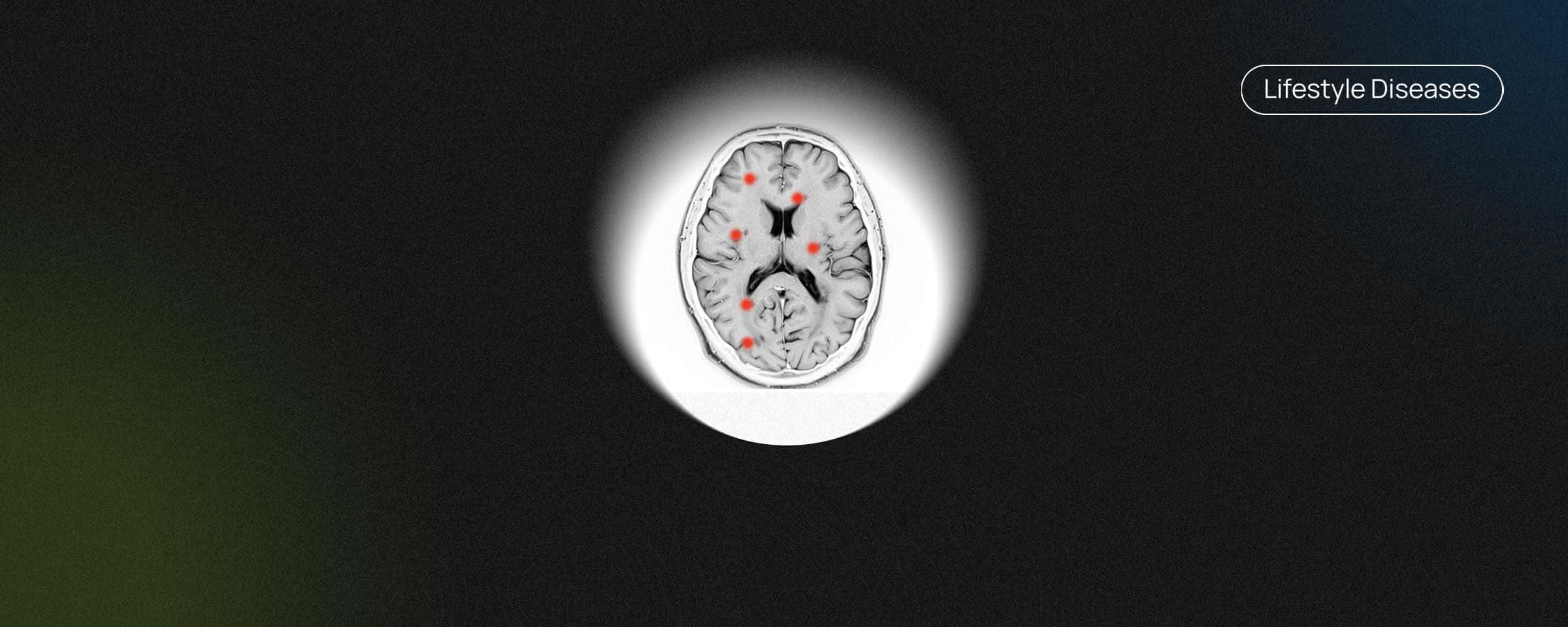 Everything You Need To Know About Multiple Sclerosis