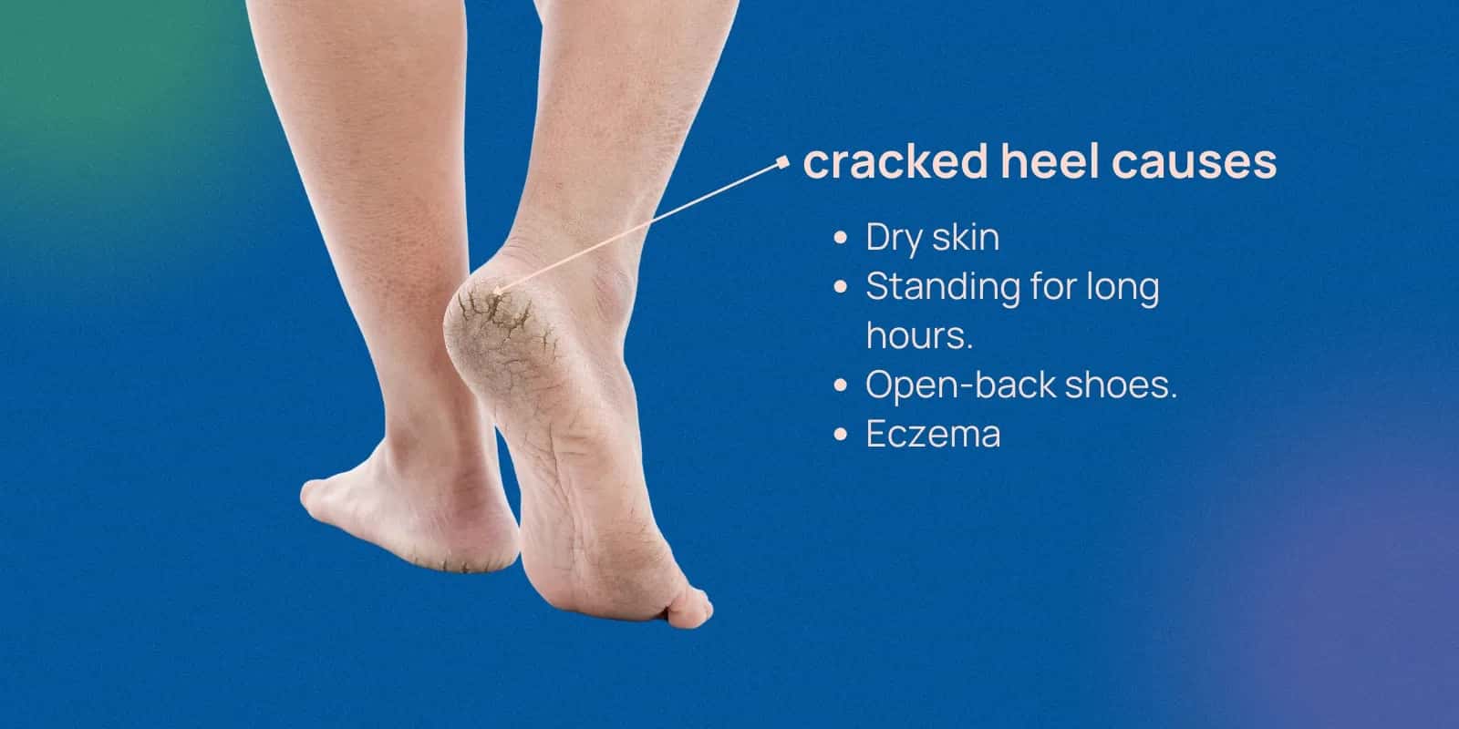 Choosing the Right Cream for Cracked Heels