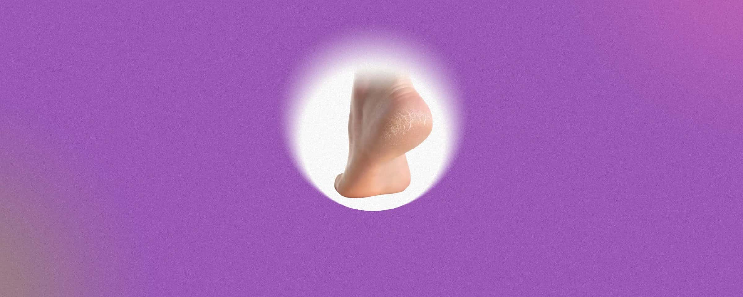 Best Creams and Remedies to Heal Cracked Heels Fast