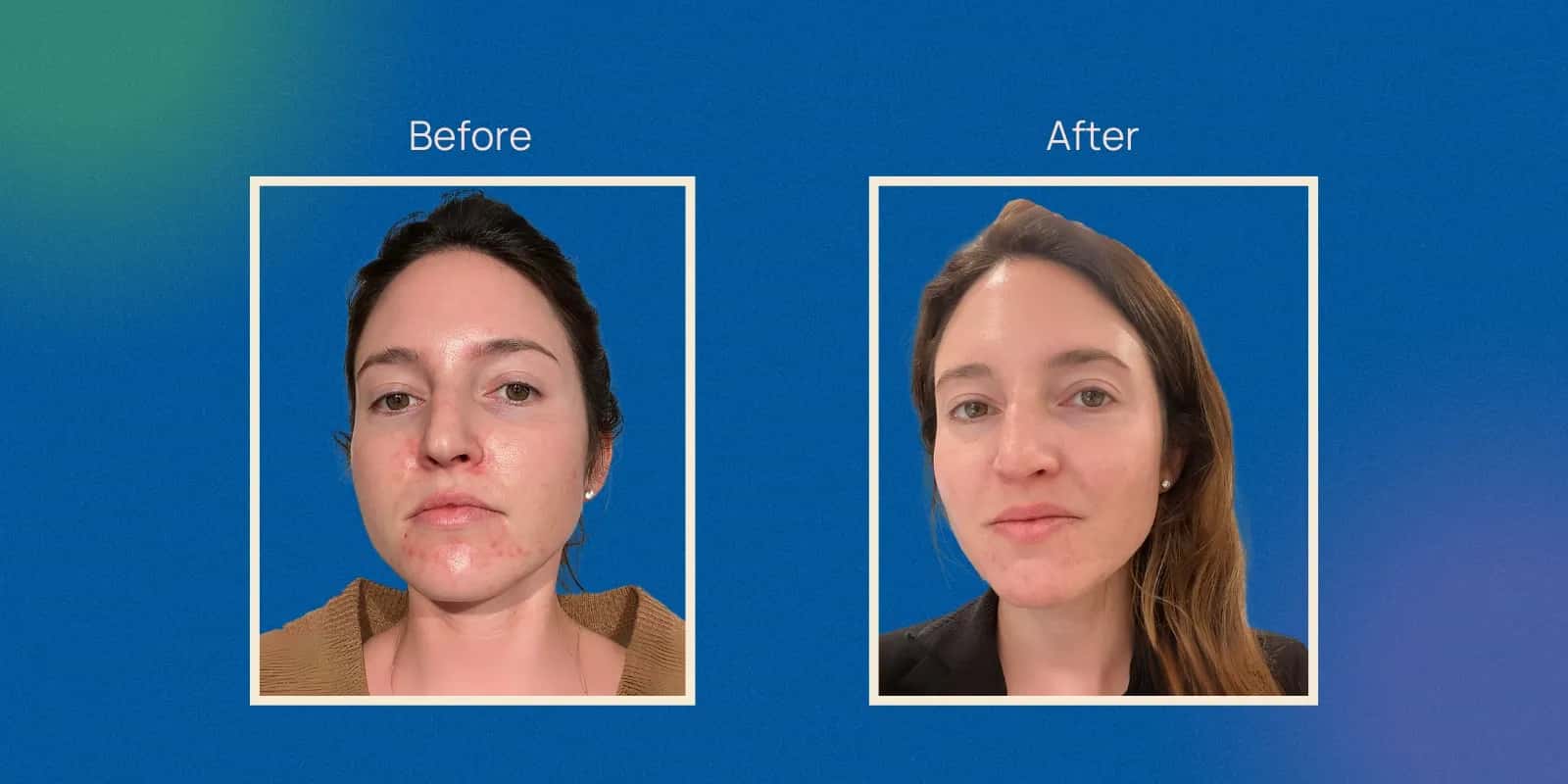 Chemical Facial Peel Cost: What Affects Price Nationwide