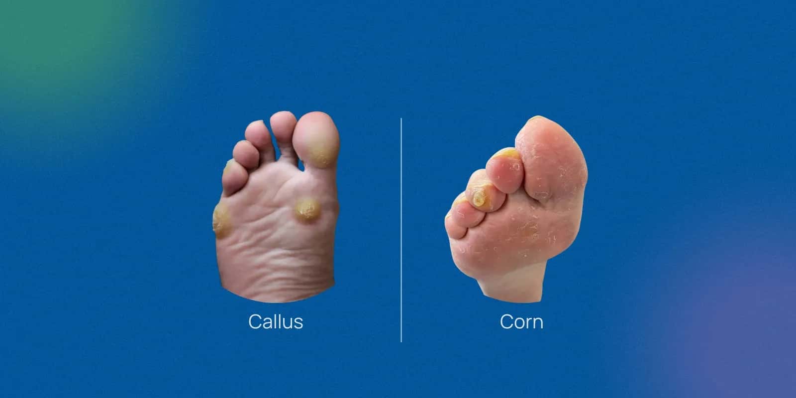 Common Uses of Terbinafine Cream and Ointment