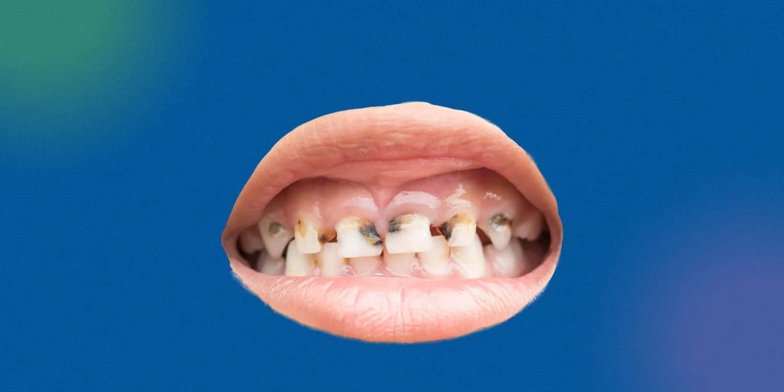Dental Cavity Classification: GV Black System and Other Types Explained