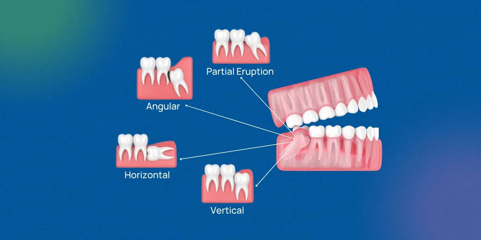 Top Home Remedies for Wisdom Tooth Pain Relief