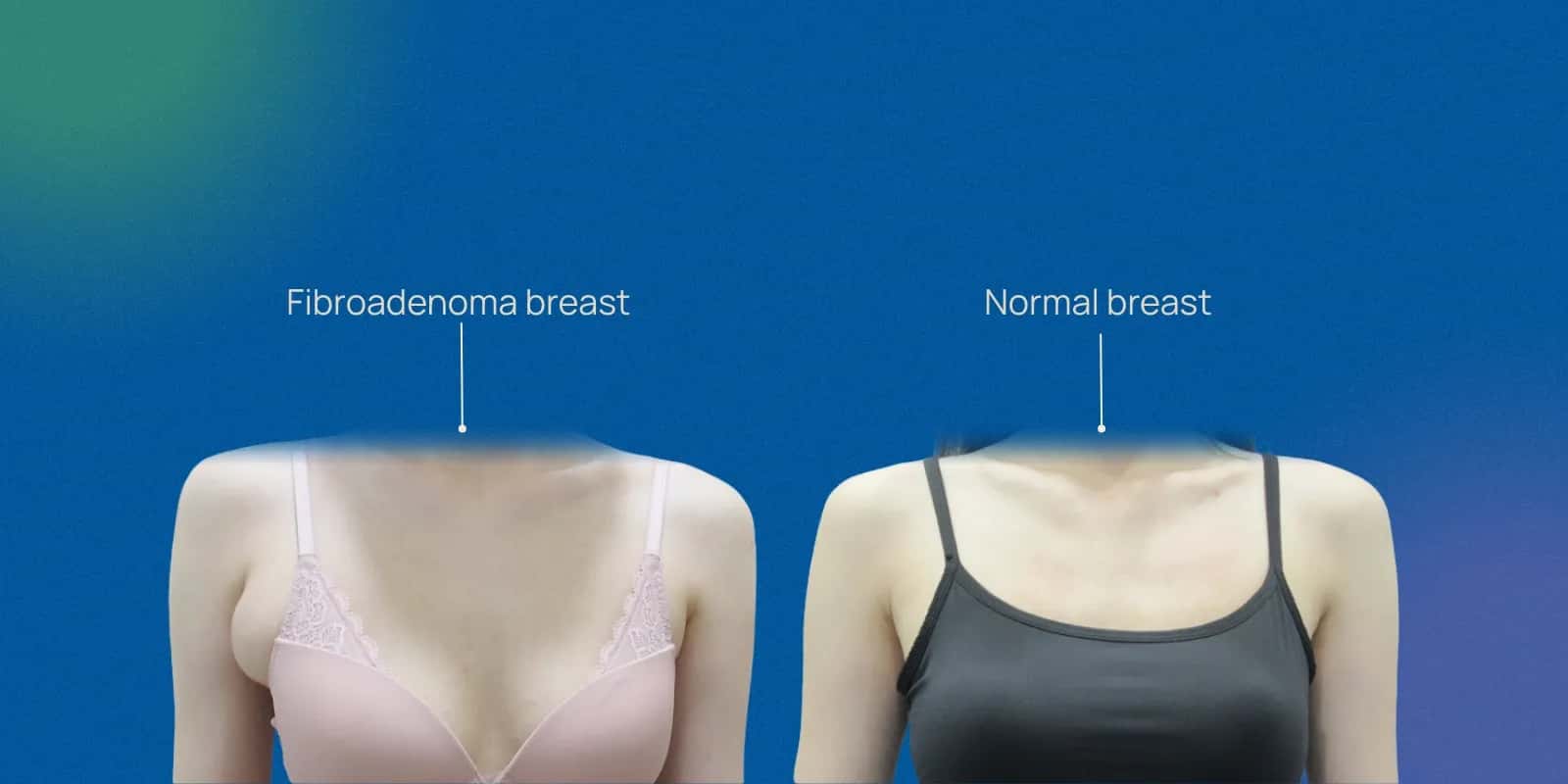 Symptoms and How Fibroadenomas Feel in the Breast