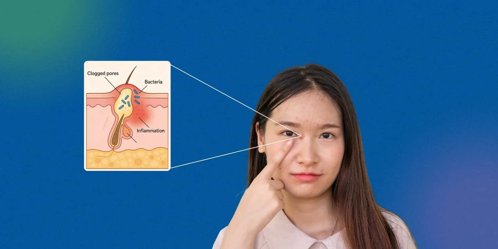 How Face Washes Containing Salicylic Acid Help Clear Pimples