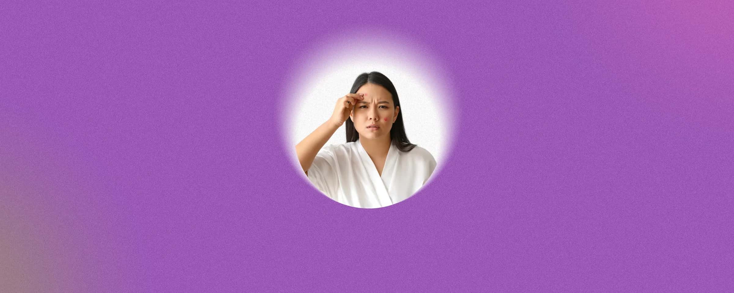 How To Get Rid of Acne: Effective Home Remedies for Pimples