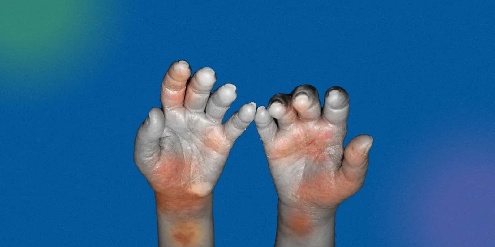 Symptoms for Lyme Disease