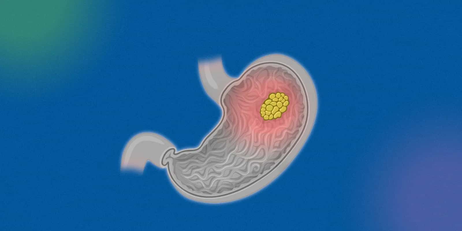 So, Where Are We At With the Gastrointestinal Cancer Scare?