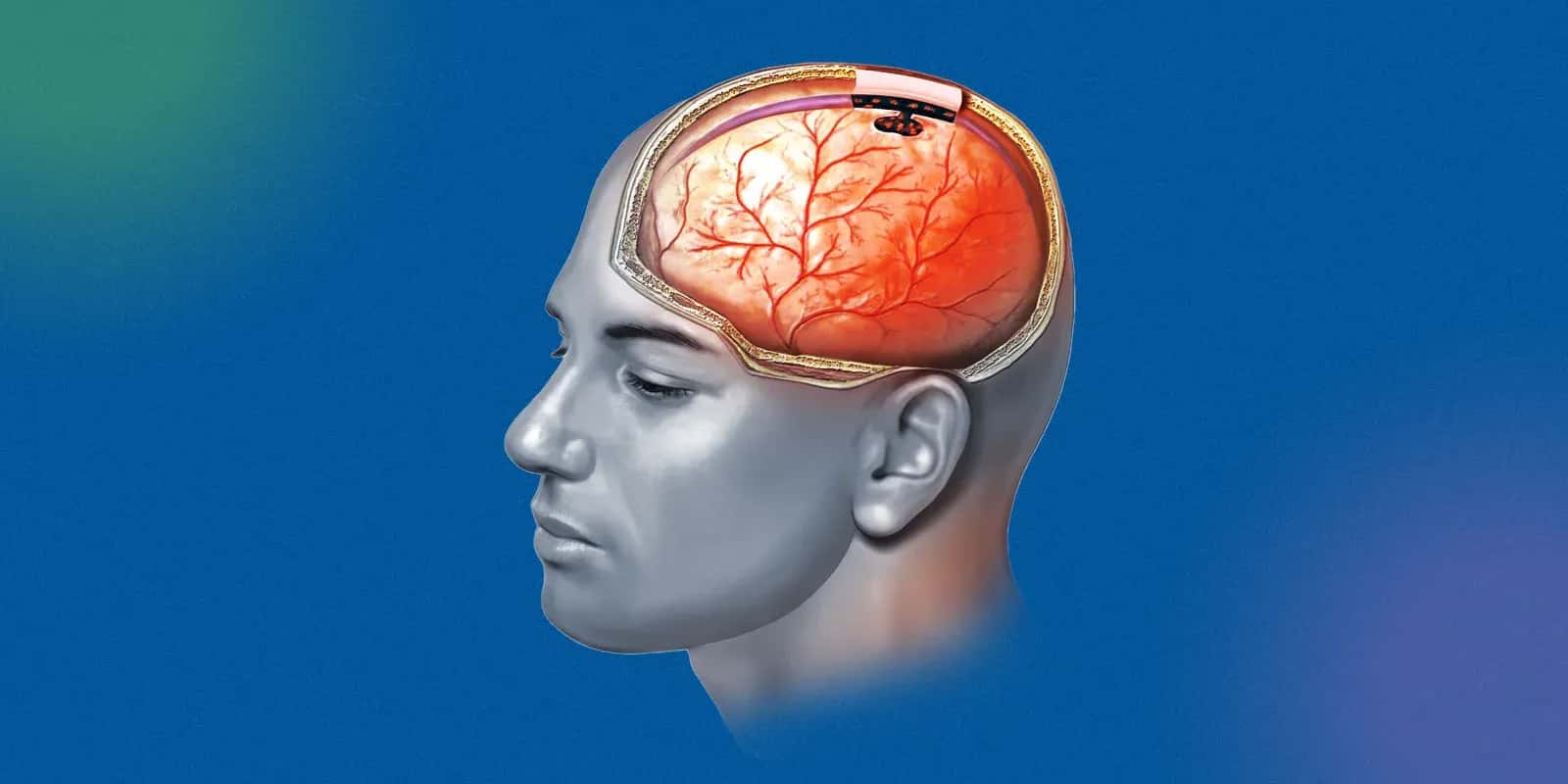 What are the stages of esthesioneuroblastoma?