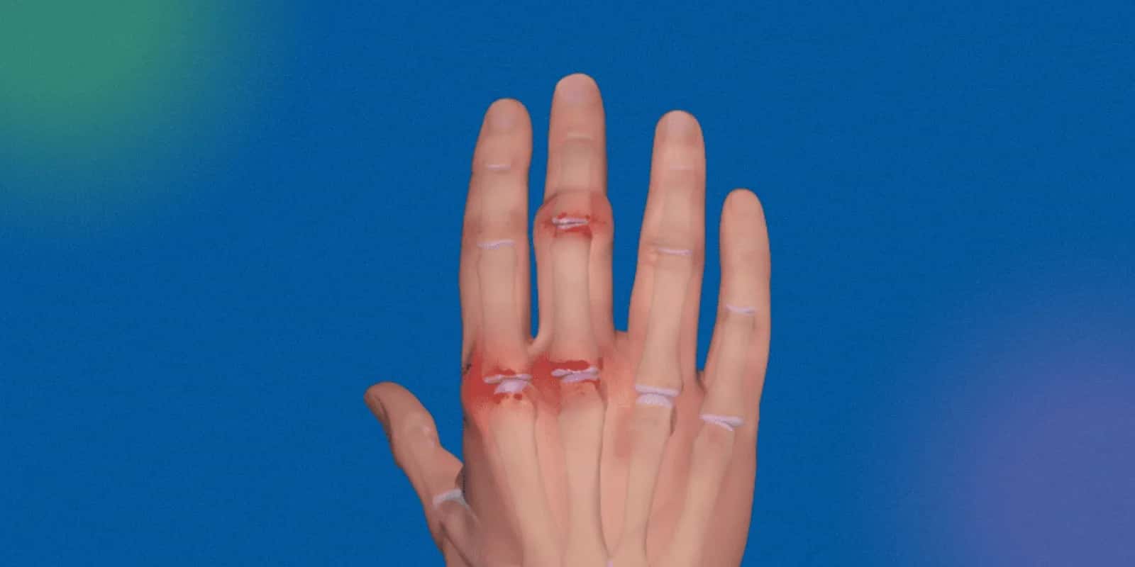 Treatment Options for Rheumatoid Arthritis