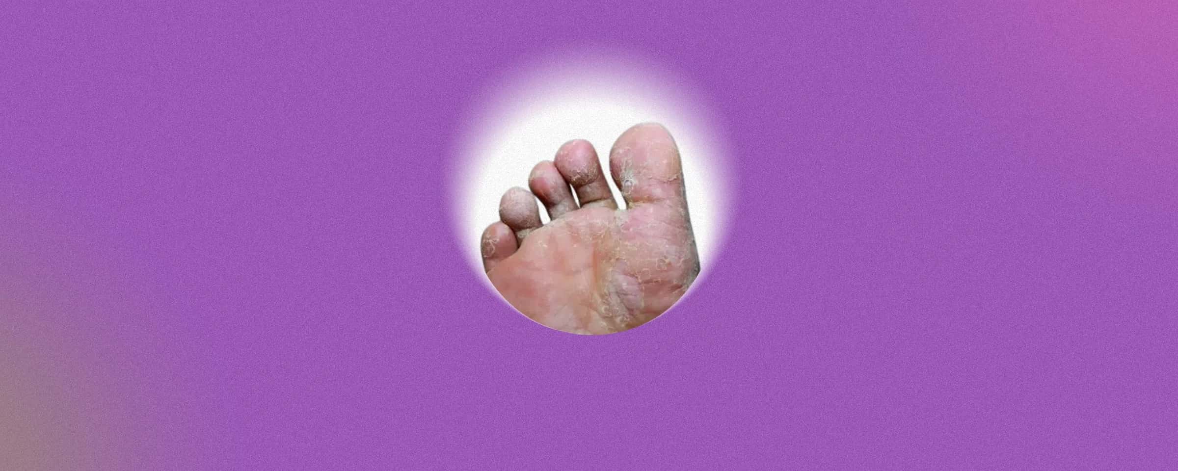 Terbinafine Hydrochloride Cream and Ointment: An Essential Guide to Antifungal Treatment