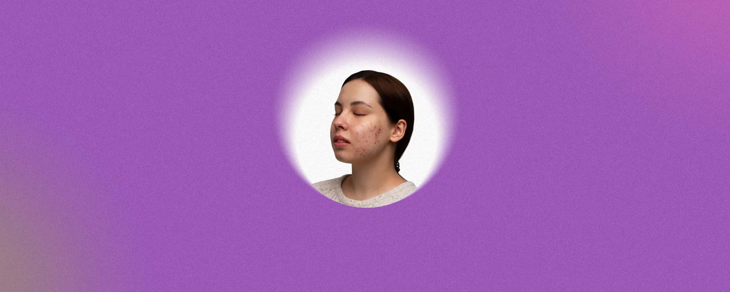 Tretinoin Cream (Topical and Ophthalmic): Overview, Uses & Key Benefits