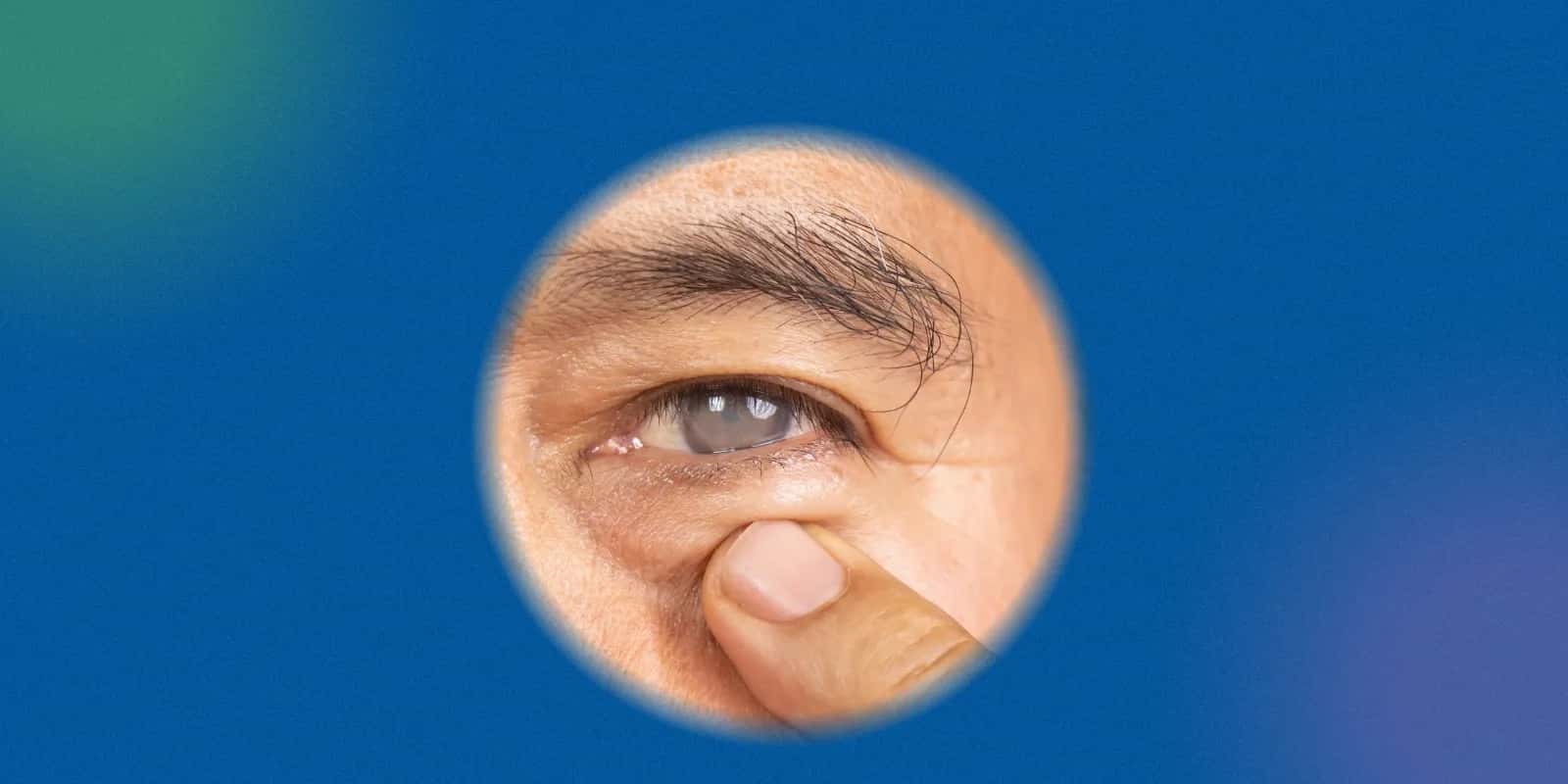 Types of Vision Defects Related to Cataracts and Other Conditions