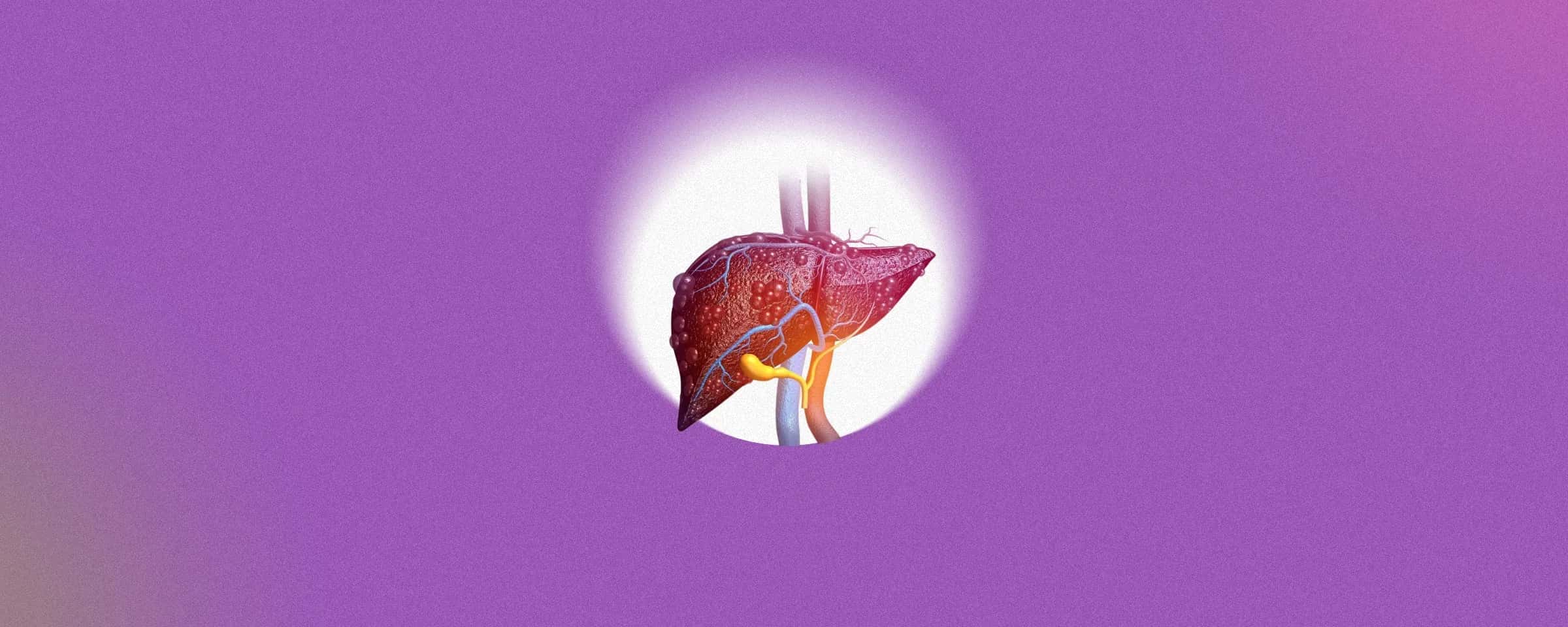 Understanding Liver Hemangioma: Definition, Causes & Importance of Early Diagnosis