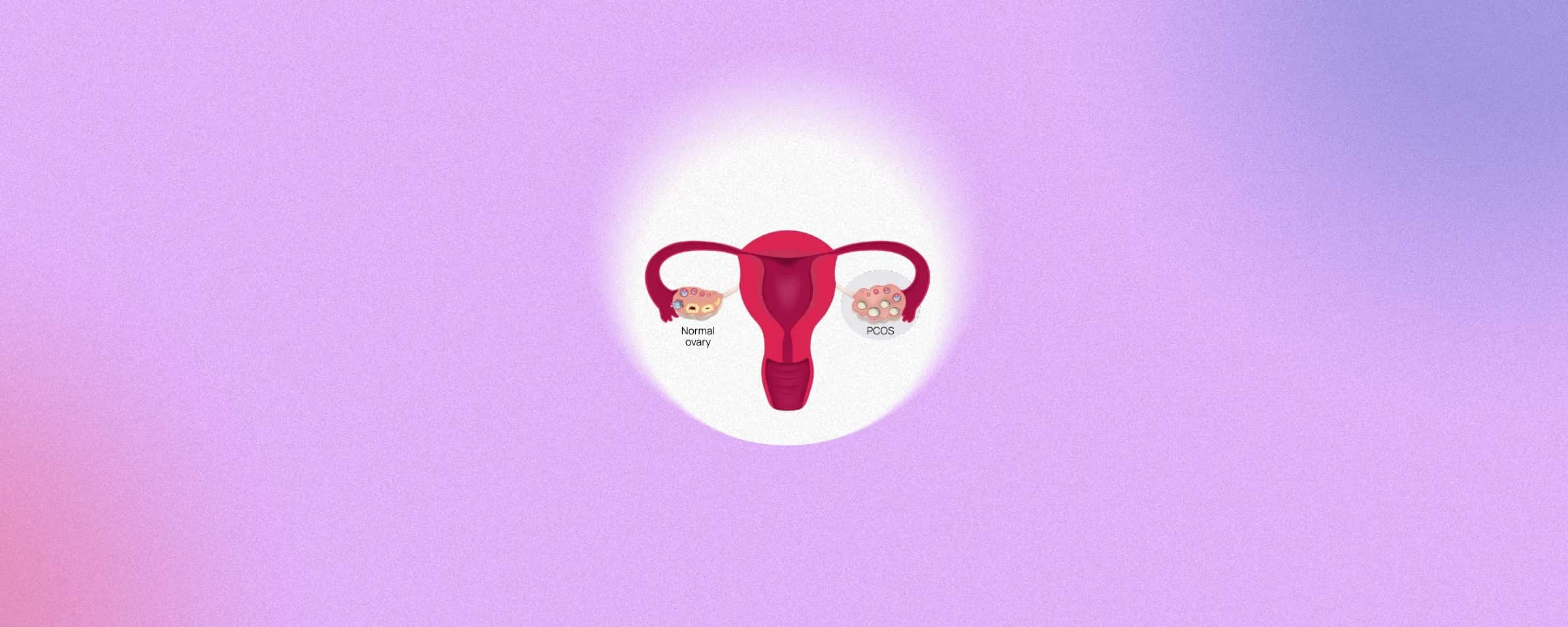 Understanding Polycystic Ovary Syndrome (PCOS): Causes and Overview