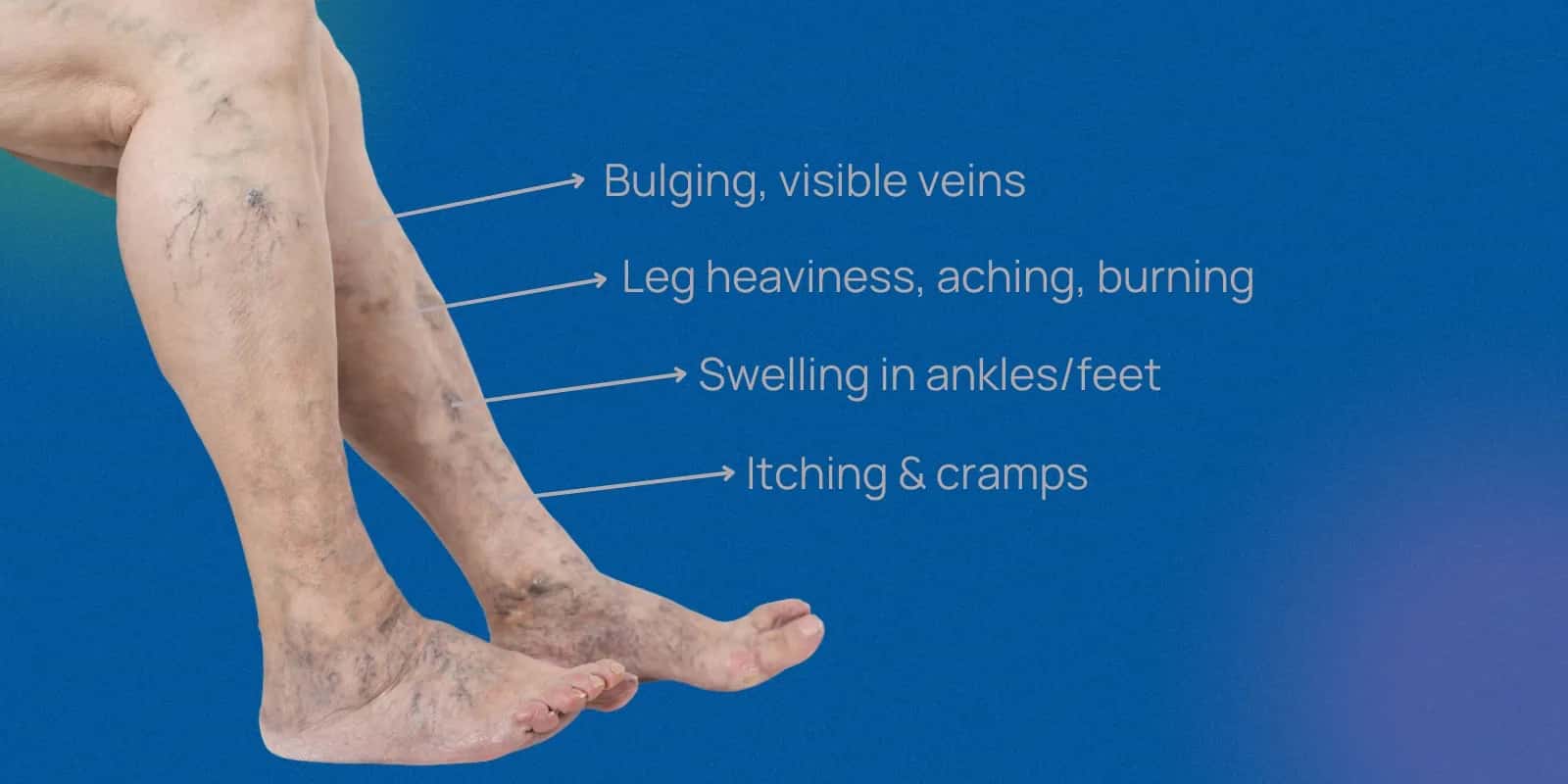 Recognising Skin Changes in Varicose Veins