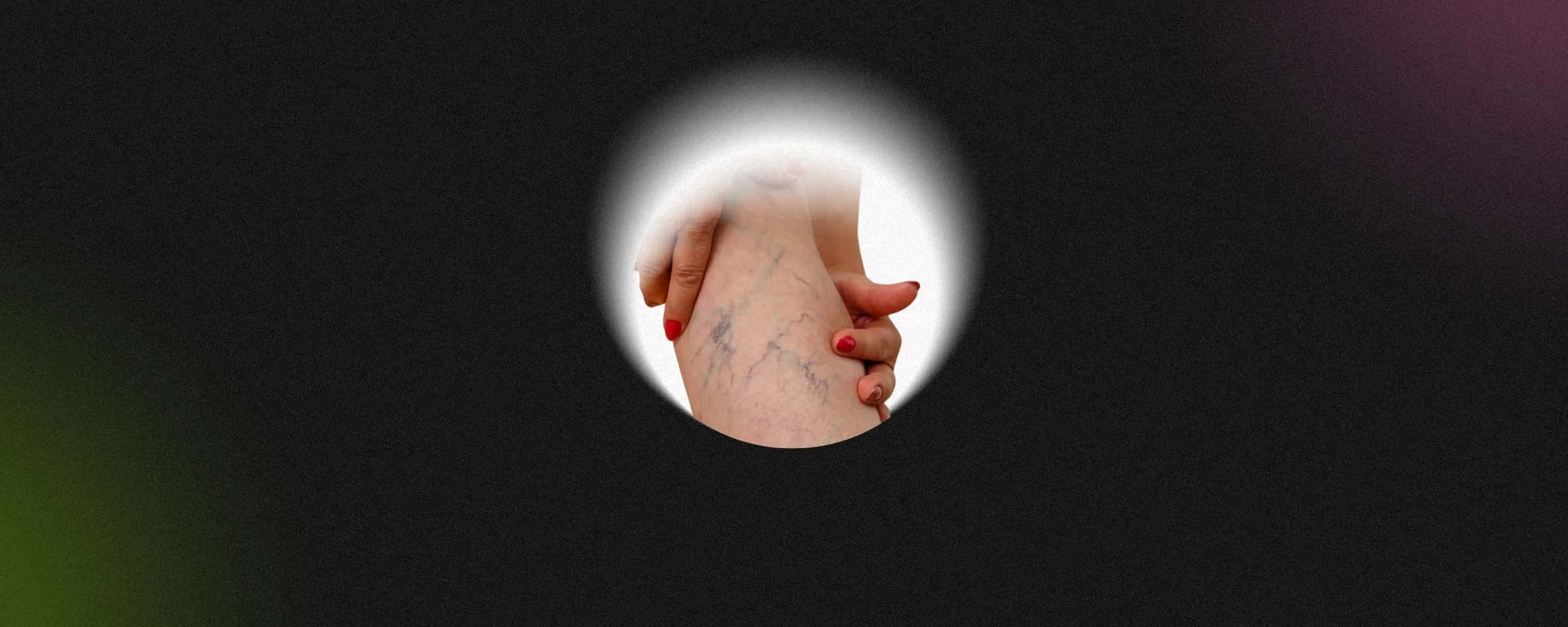 Understanding Varicose Veins: Symptoms and Causes